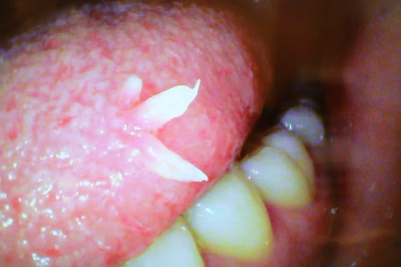 舌 に でき もの 痛い 舌がヒリヒリ痛い 治らない場合の原因と治療は