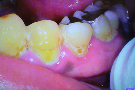 黄色い虫歯は虫歯が進行している証拠 東陽町歯科医院