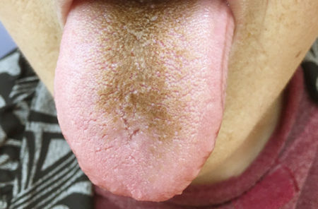 口内炎 唇の痛み 東陽町歯科医院